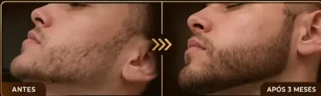 Barba antes e após 3 meses de tratamento