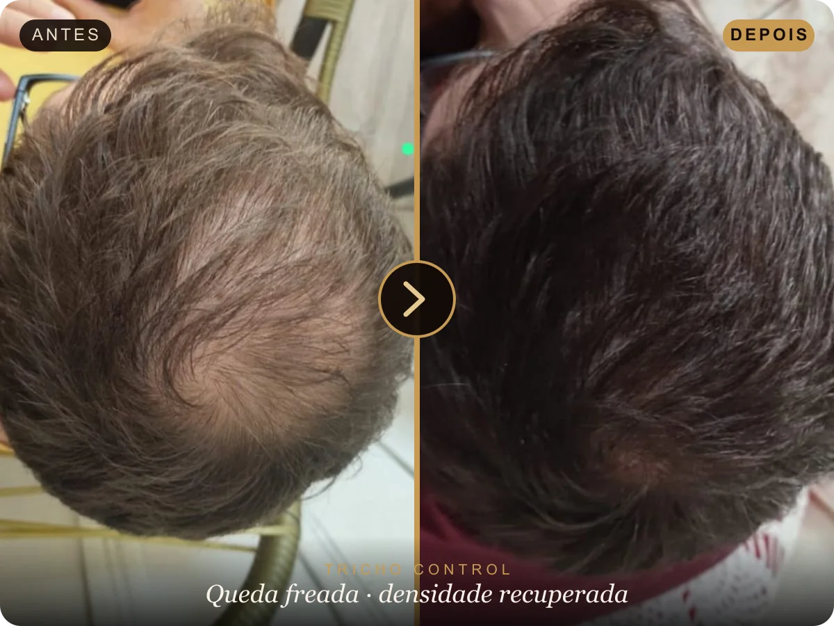 Antes e depois do tratamento de queda na coroa — queda freada e densidade recuperada