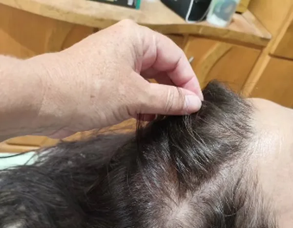 Avaliação de queda de cabelo feminina, com análise da risca